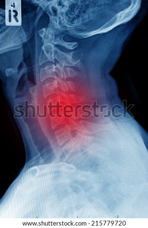 the horror of spinal injuries in humans Spinal cord injury levels & classification wise young in human, the spinal cord ends at l2 vertebral level the tip of the spinal cord is called the conus. the horror of spinal injuries in humans Spinal cord injury levels & classification wise young in human, the spinal cord ends at l2 vertebral level the tip of the spinal cord is called the conus.