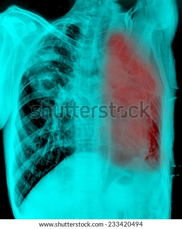 Lung cancer, pleural effusion - stock photo