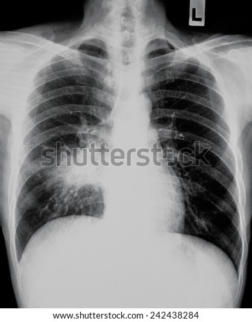 film Chest of a pneumonia - stock photo