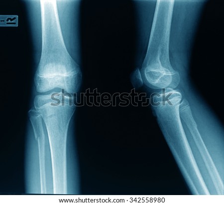 Collection Xray Normal Knee Stock Photo 73834516 - Shutterstock