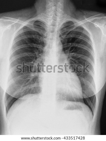 Human Chest Xray Elderly Person Stock Photo 49533298 - Shutterstock