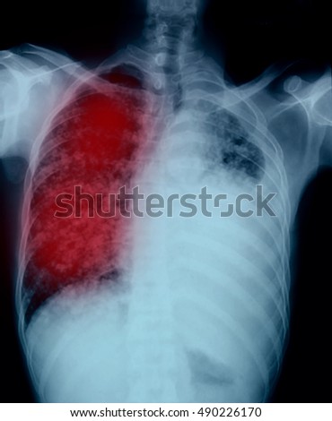 Pleural Effusion Stock Images, Royalty-Free Images & Vectors | Shutterstock