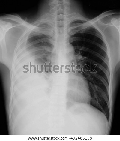 Pneumonia Test Scanning Modern Xrays Radiography Stock Photo 228972604 ...