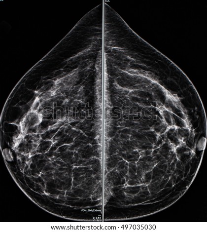 Remarkable, very Mri breast cancer diagnosis hope Mri breast cancer diagnosis