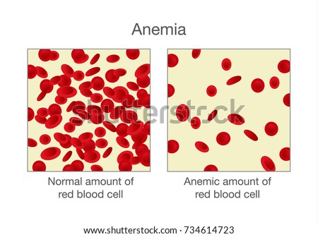 Anemia Stock Images, Royalty-Free Images & Vectors | Shutterstock