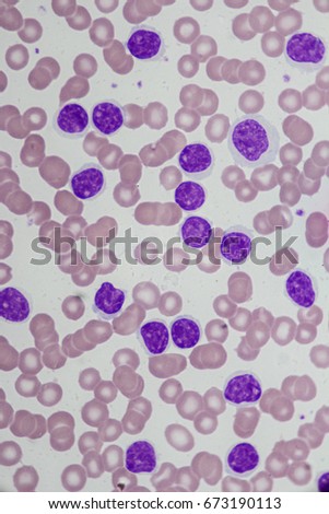 Leukemia Stock Images, Royalty-Free Images & Vectors | Shutterstock