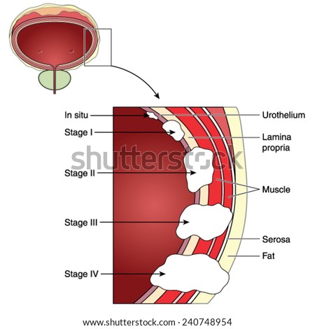 Bladder cancer stage iv