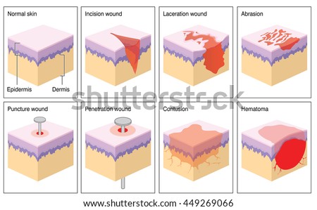 Various Types Skin Wound Stock Illustration 449269066 - Shutterstock