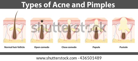 Types Acne Structure Pimple Detailed Drawing Stock Vector 436501489 ...