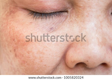 Liver Spots Stock Images, Royalty-Free Images &amp; Vectors 