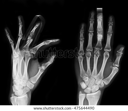 Xray Two Hands Extended Frontal View Stock Photo 93065107 - Shutterstock