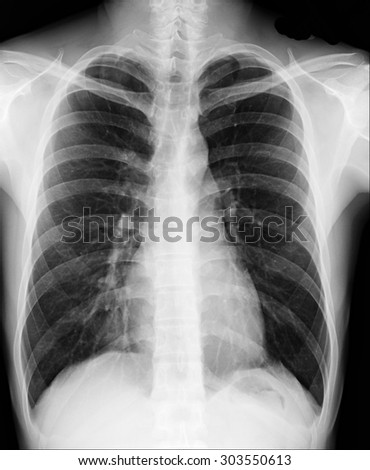 Xray Image Human Healthy Chest Stock Photo 303550613 - Shutterstock