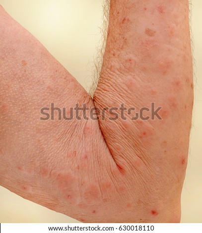 Scab Stock Images, Royalty-Free Images & Vectors | Shutterstock