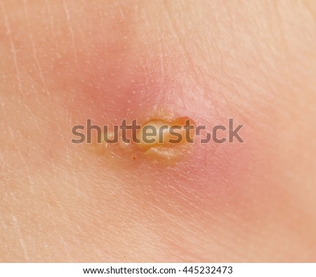 Skin Boils Stock Images, Royalty-Free Images & Vectors | Shutterstock