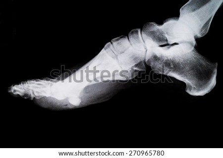 X Ray Foot Bones Ankle Stock Photo 270965780 - Shutterstock