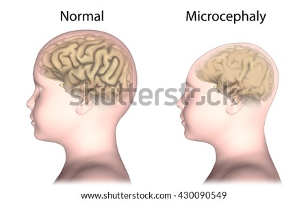 microcephaly compared normal head size now stock illustration normal photo size