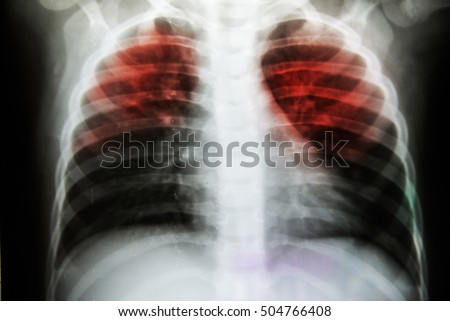 Picutes of tuberculosis