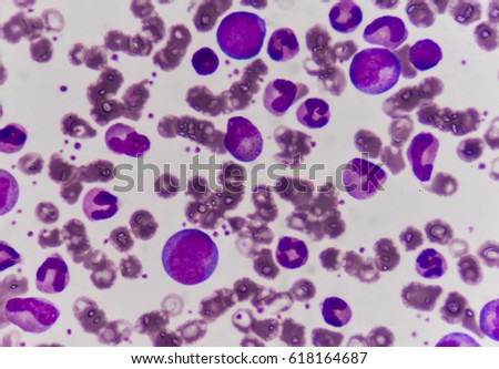acute lymphocytic leukemia in children health and social care essay Ds85-4 case study 85 ¦ acute lymphoblastic leukemia significance approximately 1,460 deaths (800 males and 660 females) due to all are expected in the united states in 2008 all is the most common cancer of childhood, representing nearly one third of all cases of pediatric cancer, 80% of all acute leukemias in children, and approximately 73% of all leukemia. acute lymphocytic leukemia in children health and social care essay Ds85-4 case study 85 ¦ acute lymphoblastic leukemia significance approximately 1,460 deaths (800 males and 660 females) due to all are expected in the united states in 2008 all is the most common cancer of childhood, representing nearly one third of all cases of pediatric cancer, 80% of all acute leukemias in children, and approximately 73% of all leukemia.