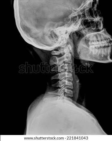 Human Neck Radiography Side View Stock Photo 221841043 - Shutterstock