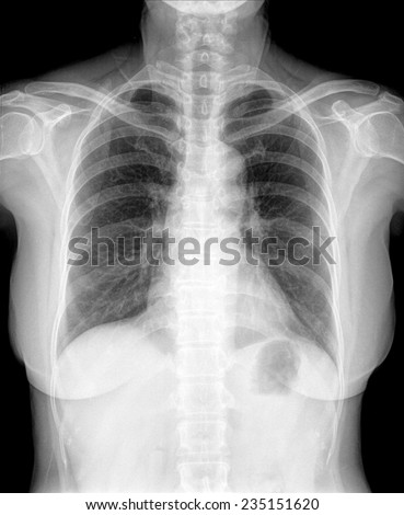 Thorax Stock Photos, Images, & Pictures | Shutterstock