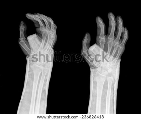 fracture distal radius (Colles' fracture) and cast , 2 position - stock ...