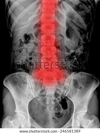 Lumbar Spine Woman Inflammation Lumbar Spine Stock Photo (Royalty Free ...