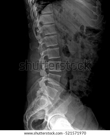 Normal Female Spine X Ray