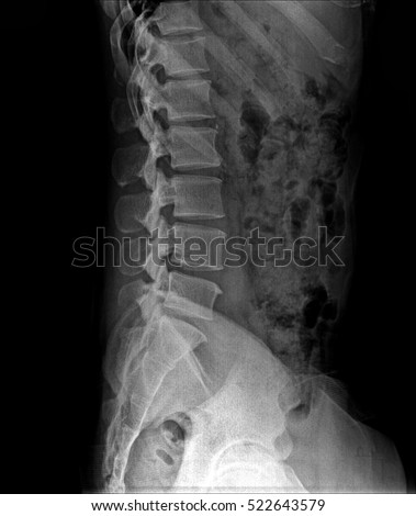 Xray Image Spine Side View Human Stock Photo 522643579 - Shutterstock