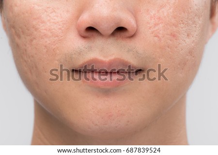 skin scar stock images royalty free images vectors scar stock images royalty free images vectors skin scar stock images royalty free images vectors scar stock images royalty free images vectors