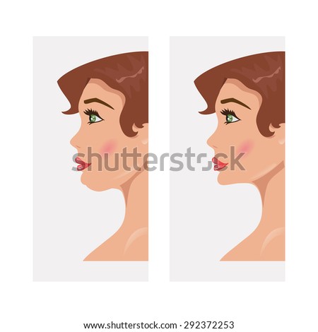 chin double normal woman illustration vector surgery shutterstock vectors chinned cartoon