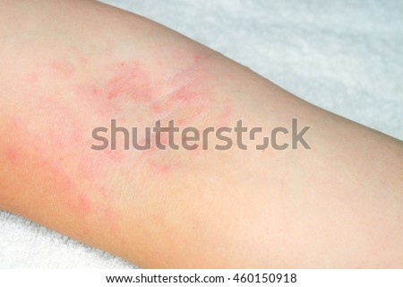 Allergic Reaction Stock Images, Royalty-Free Images & Vectors ...