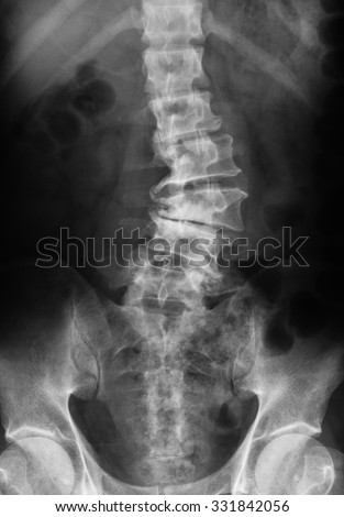 Xray Image Lumbosacral Spine Showing Osteoarthritis Stock Photo ...