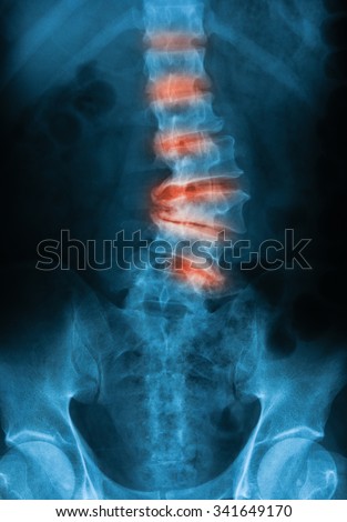 Osteoarthritis Stock Photos, Royalty-Free Images & Vectors - Shutterstock