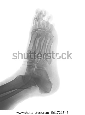 Metatarsal Stock Images, Royalty-Free Images & Vectors | Shutterstock