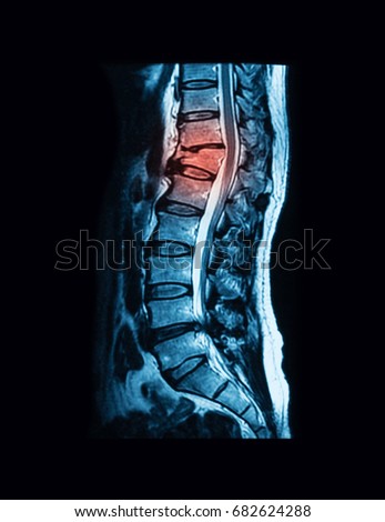 CT (Computed tomography) of the lumbosacral (L-S) spine, case of motorcycle accident (MCA), Showing L1 compression fracture