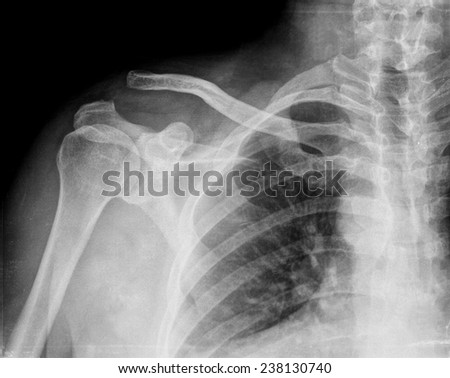 Regular Shoulder On Xray Stock Photo 236826454 - Shutterstock