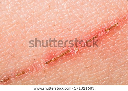 macro scar on the human skin stock photo image 61059545 skin scar stock images royalty free images vectors macro scar on the human skin stock photo image 61059545 skin scar stock images royalty free images vectors