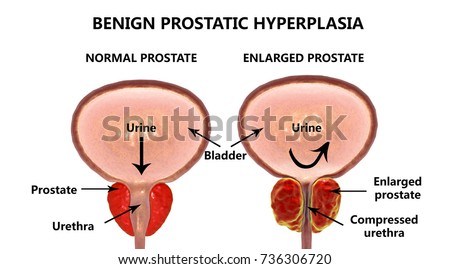 Cialis dosage for enlarged prostate