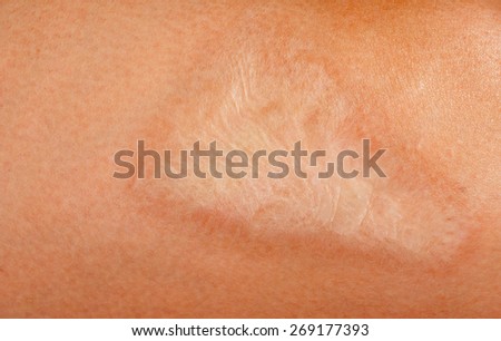 scar on human skin stock photo 97015703 skin burn stock images royalty free images vectors scar on human skin stock photo 97015703 skin burn stock images royalty free images vectors