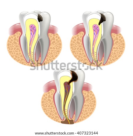 Red cross toothache for abscess