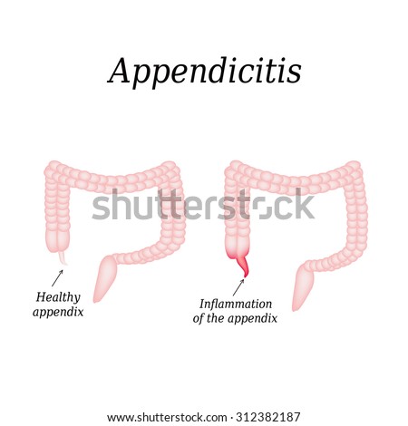 Appendix Stock Photos, Royalty-Free Images & Vectors - Shutterstock