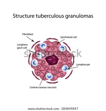 Granuloma Stock Images, Royalty-Free Images & Vectors | Shutterstock