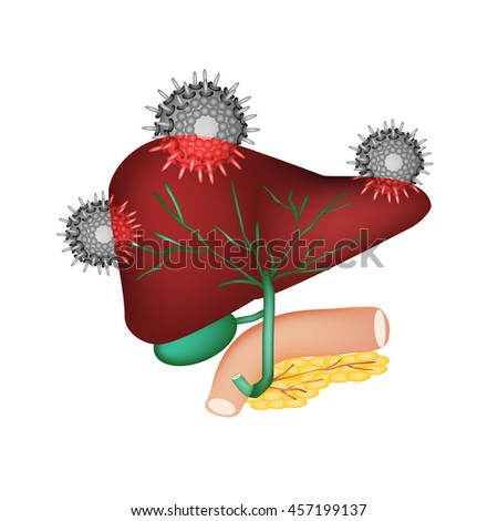 an introduction to the disease of hepatitis Introduction: some reports have considered hepatitis a as a possible factor in the development of acute decompensation in patients with wilson's disease. an introduction to the disease of hepatitis Introduction: some reports have considered hepatitis a as a possible factor in the development of acute decompensation in patients with wilson's disease.