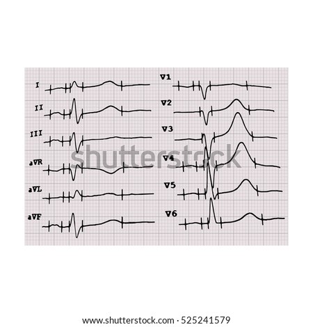 cardiogram heartbeat graph on graph paper stock vector 525241579 music graph paper