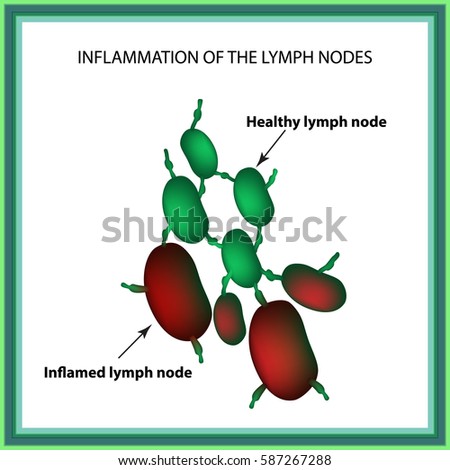 Lymph Stock Images, Royalty-Free Images & Vectors | Shutterstock