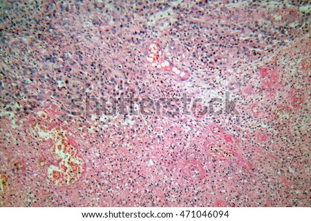 human skin cells stock photos human skin cells stock images alamy cells human skin melanoma skin cancer stock photo 471046067 human skin cells stock photos human skin cells stock images alamy cells human skin melanoma skin cancer stock photo 471046067