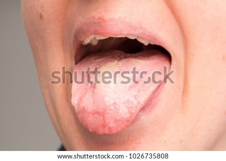 Candida Albicans Stock Images, Royalty-Free Images & Vectors | Shutterstock