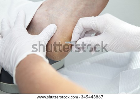 Loại bỏ Callas khô chân trong closeup