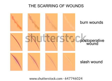 skin scar stock images royalty free images vectors scar stock images royalty free images vectors skin scar stock images royalty free images vectors scar stock images royalty free images vectors