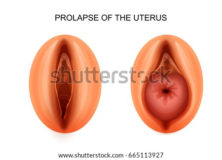 Uterus In Sex Pictures 21